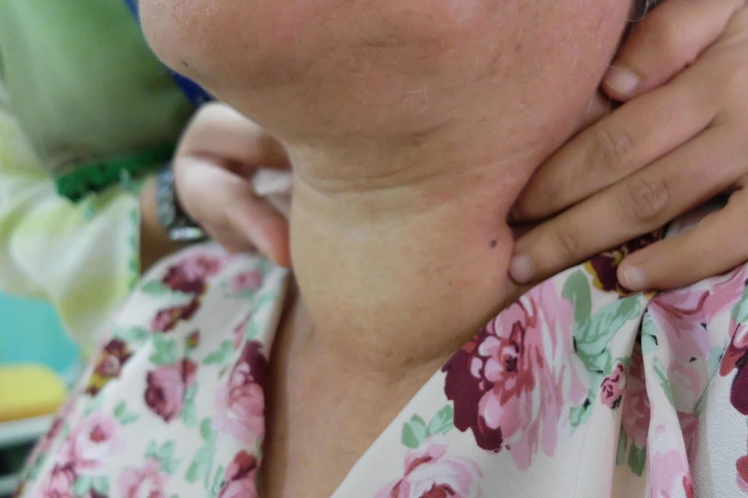 женщина с заболеванием щитовидной железы